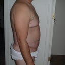 TUMMY ONE DAY AFTER MPX SMART LIPO